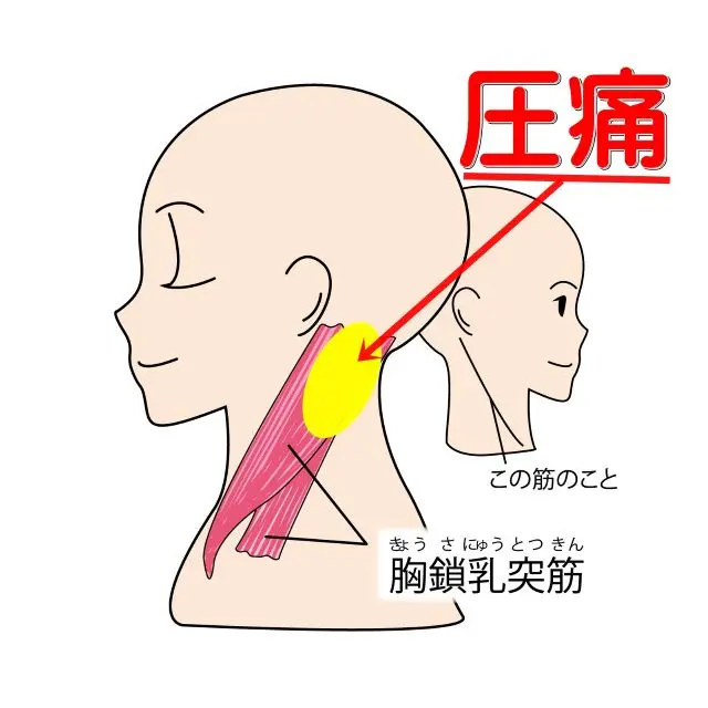 扁桃・上咽頭の炎症で反応が出やすい部位（胸鎖乳突筋）の図
