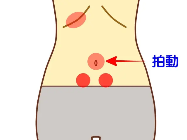 更年期障害による腹診の反応点