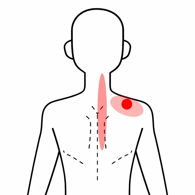 寝違えにより首から背中にかけて広がる痛みの位置を示す人体図