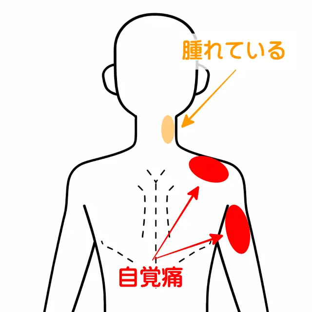肩関節脱臼後の肩上部と腕後面の痛みの部位を示す人体図