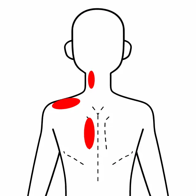 3ヶ月続いた左首から肩甲間部の痛みの位置を示す人体図