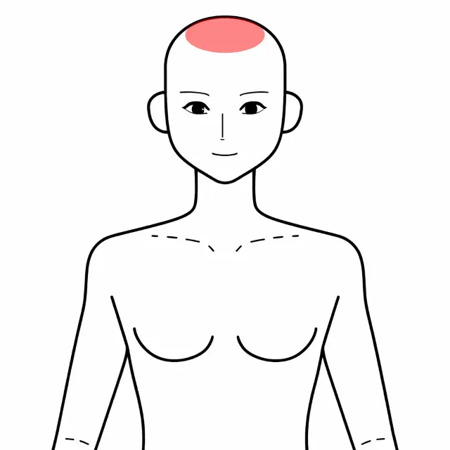 更年期障害で起きた頭痛の位置を示すイラスト