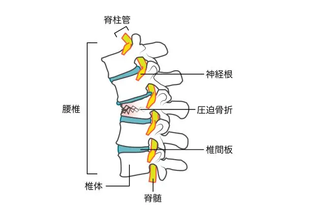 脊脊椎圧迫骨折の解説図