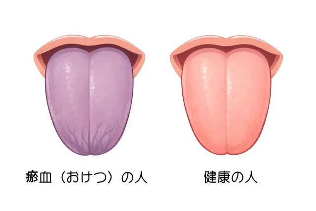 瘀血(おけつ)と健康の人を対比させた舌のイラスト