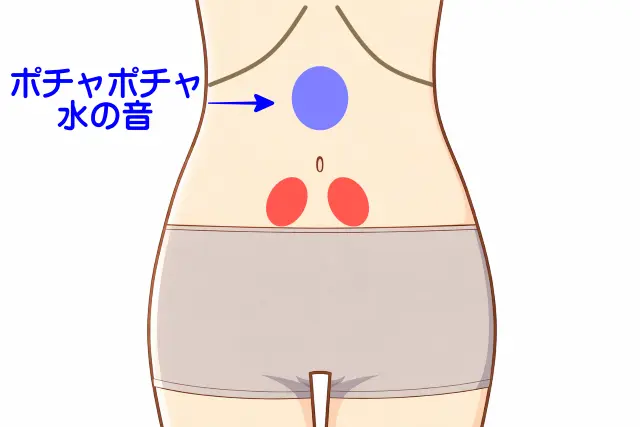 胃内停水がみられた腹診の反応部位