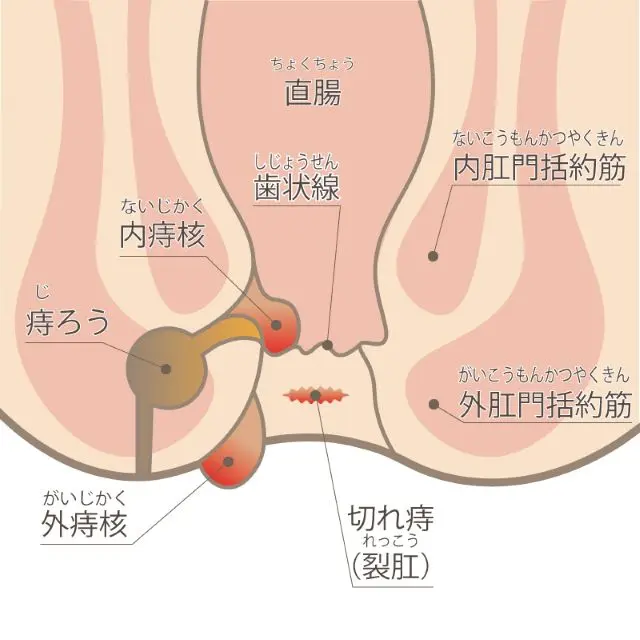 痔の種類を示すイラスト