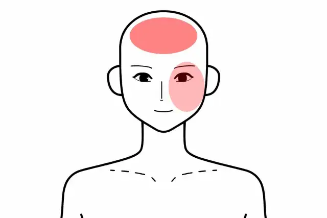 前頭部の頭痛の部位