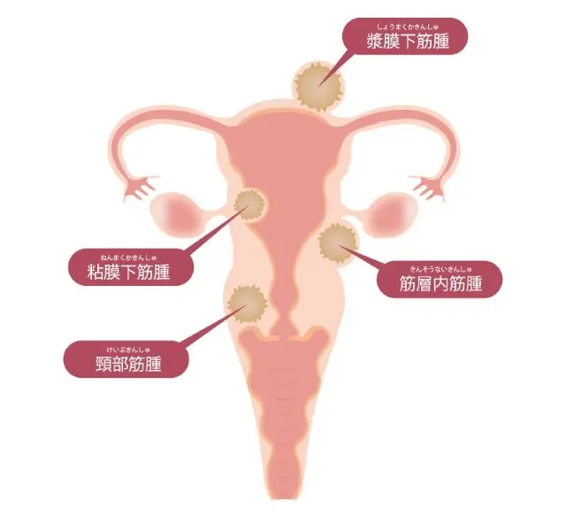 子宮筋腫のイラスト