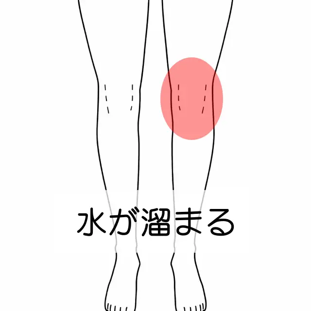左膝の痛みの位置を示す図