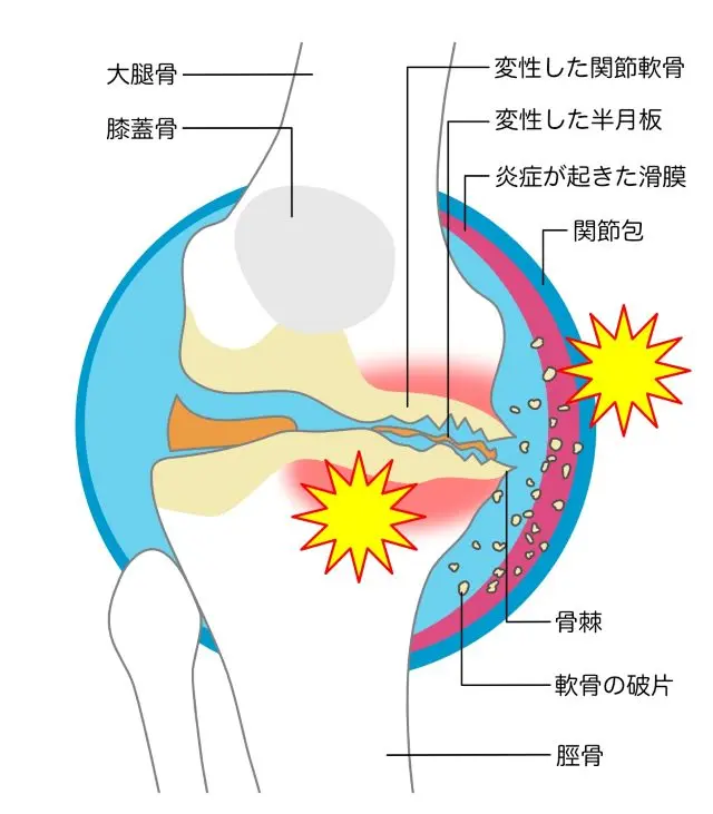 変形性膝関節症の状態を示した図