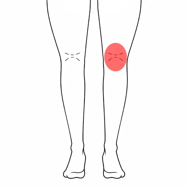 右膝裏の痛みの位置を示す図