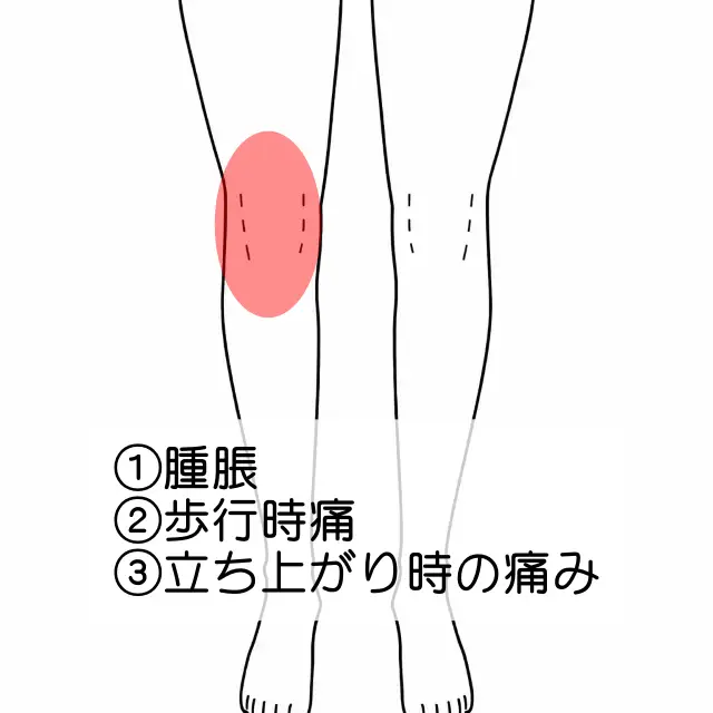 右膝の痛みの位置を示す図