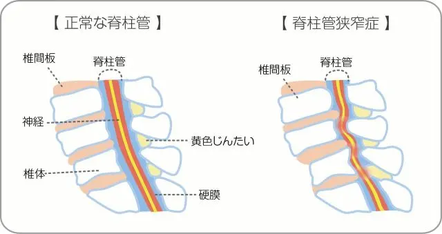 脊柱管の状態を示した図