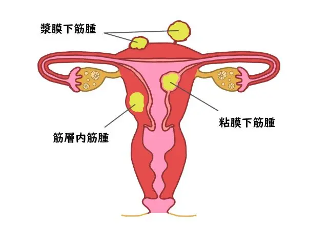 子宮筋腫の分類図