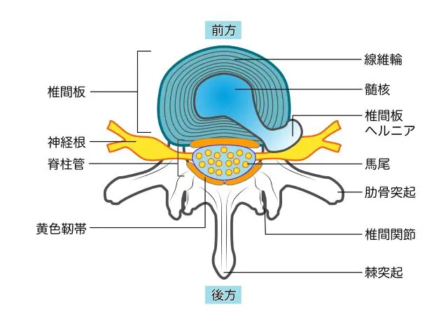 腰椎椎間板ヘルニアの構造を示す図