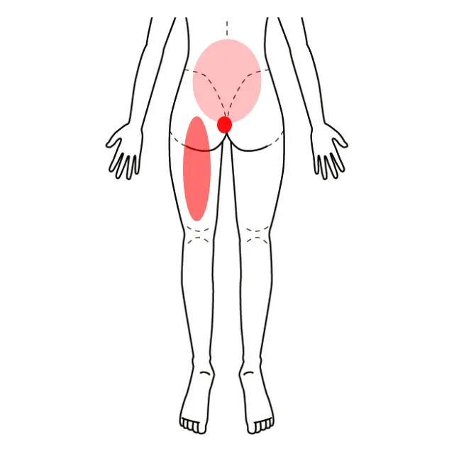 腰や尾骨、太ももの痛みとしびれの位置を示した図