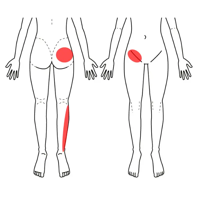 鼠径部、お尻、下腿外側の痛みを示した図