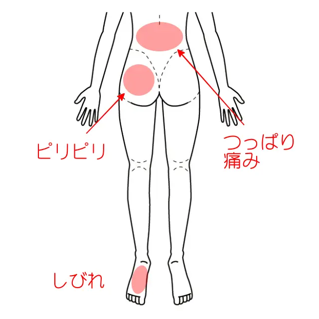腰や臀部、足底の痛みとしびれの位置を示した図