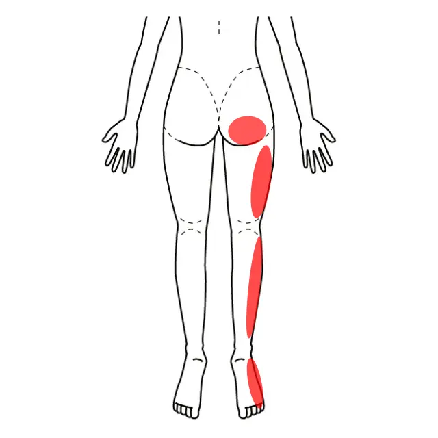 右臀部から足先までの痛みとしびれの位置を示した図