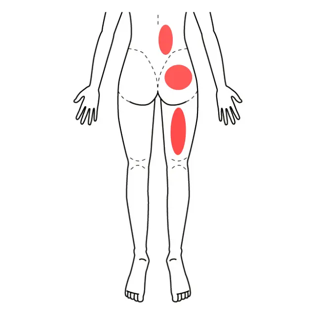 右腰、臀部、太ももの痛みを示した図