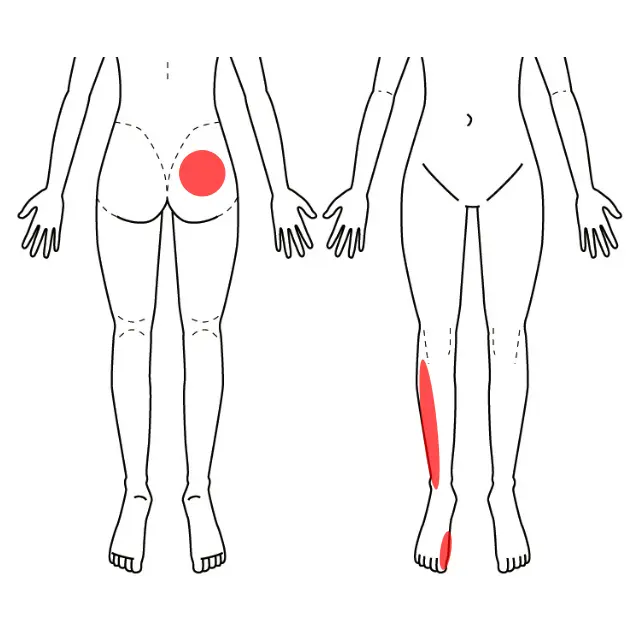 右臀部、脛の外側、親指の痛みとしびれを示した図