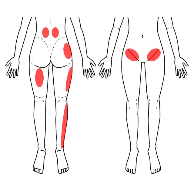 腰から右大腿外側・右下腿外側の痛みとしびれを示した図