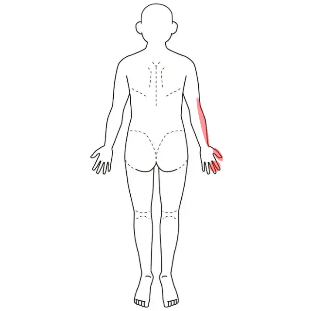 右腕と指先のしびれと痛みの位置を示した人体図