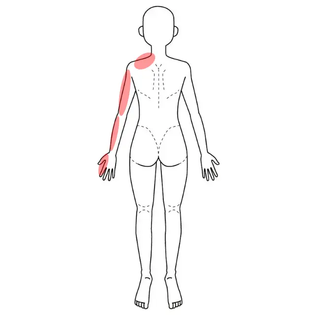 左腕と指先の痛みとしびれの位置を示した人体図