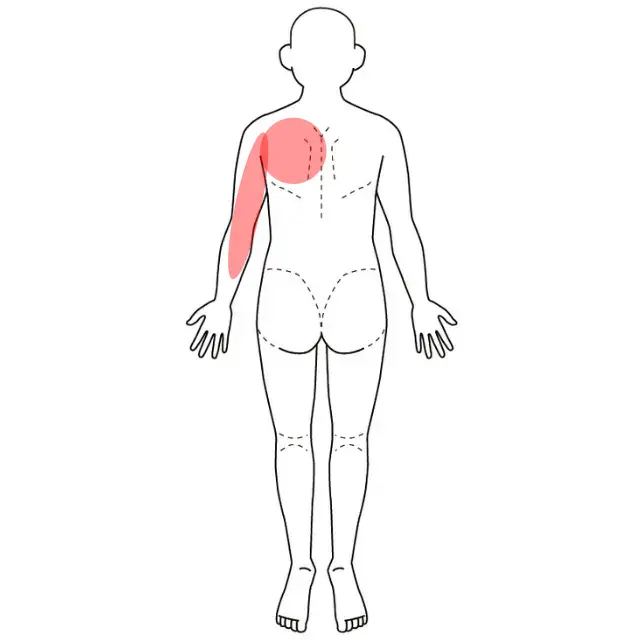 左肩甲間部と上肢のしびれと痛みの位置を示した人体図