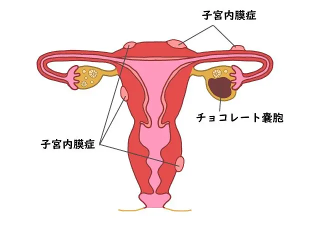 子宮内膜症の位置を示す子宮の図
