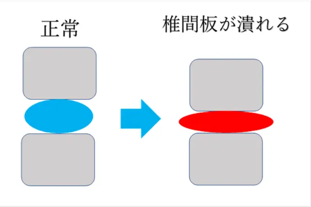 正常と膨隆のある椎間版を対比させた図