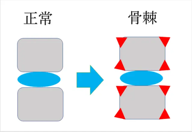 正常と骨棘のある椎体を対比させた図