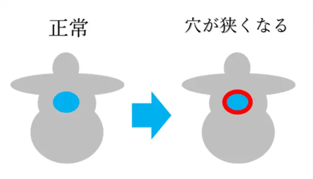 正常と椎孔が狭い椎体を対比させた図