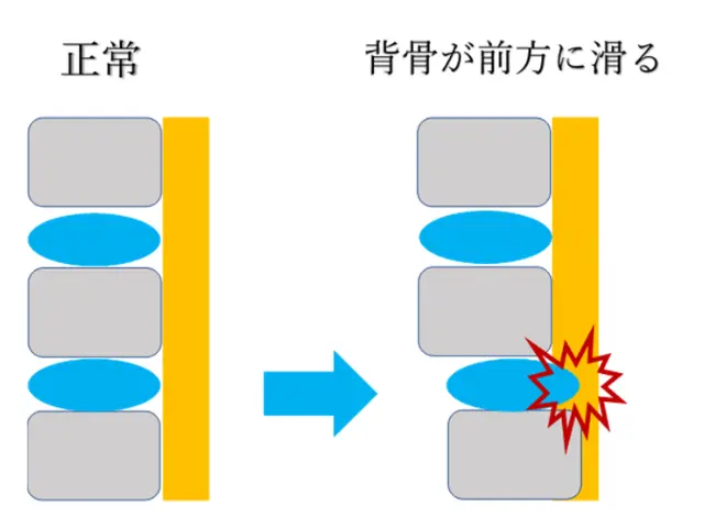 正常と前方に滑った椎体を対比させた図